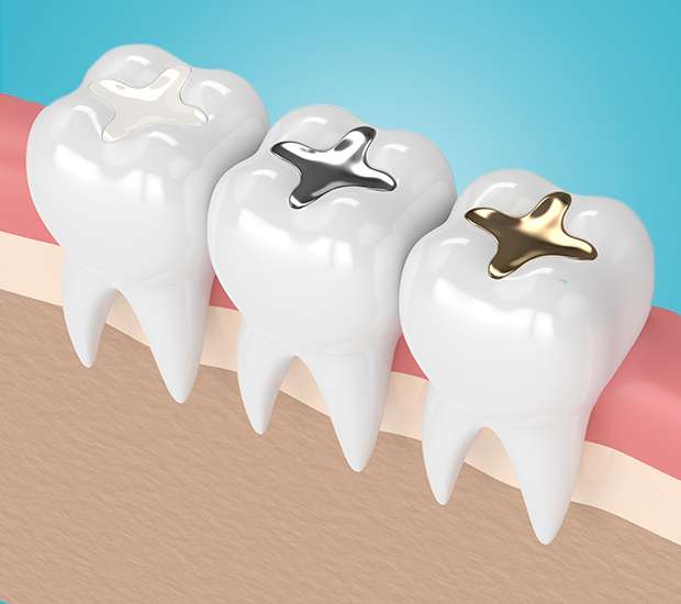 Independence Composite Fillings
